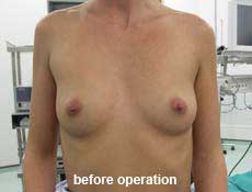 plastic-surgery-breast-augmentation 
